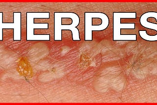 Genital Herpes: A Detailed Overview