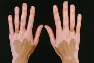 Forty years living with vitiligo