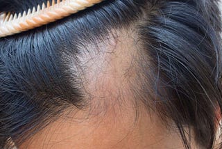 Different Types Of Hair Loss