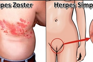 Cara Mengobati Herpes Di Kaki