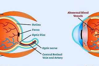 Diabetic Retinopathy Detection