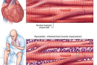 Myocarditis after vaccination against COVID