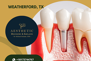 Dental Implants: A Lasting Solution for Missing Teeth in Weatherford, TX