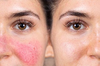 Understanding Rosacea Skin: Causes, Symptoms, Treatment, and Prevention