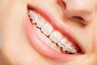 Clear Braces in Boca Raton