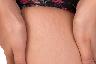 10 Stretch Mark Remedies That Actually Work