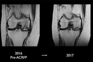 Knee pain: ‘The hidden lesions’ and novel treatments