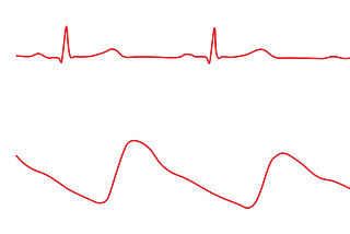 Synthesizing Electrocardiogram (ECG) from Photoplethysmogram(PPG) using Generative Adversarial…