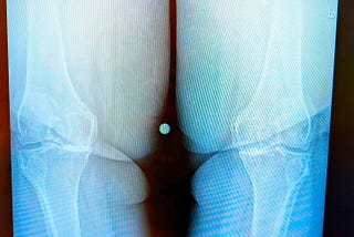 An X-ray image shows a clear view of two knee joints. The bones appear with distinct outlines against a dark background.