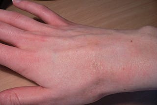 Here Are The 7 Best Home Remedies For Scabies