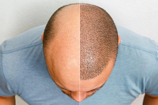 How To Pick The Best Hair Transplant In Gurgaon?
