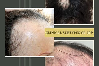 Cicatricial Alopecia: How Lichen Planopilaris Leads to Permanent Hair Loss — Understanding the Link