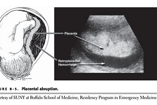 Topic 9a. Placental abruption: pathomechanism, diagnosis, differential-diagnosis