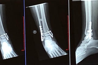 Broken Ankle Trimalleolar Fracture