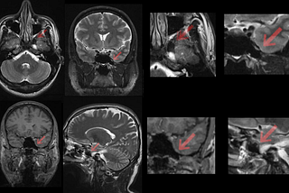 “Neurological and Circulatory Interplay: Unraveling Symptomology and COVID-19 Impact in a Complex…