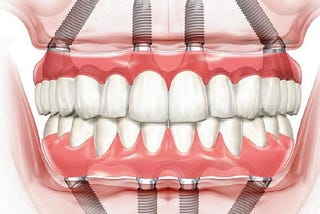 Full Mouth Dental Implants in Turkey