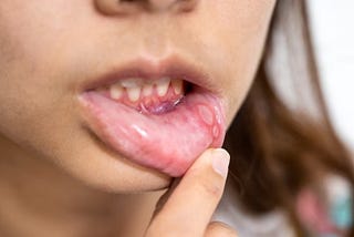 what does hpv mouth cancer look like west olds dental dentist guide