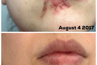A comparison from August 2017 to July 2020 showing the improvement of the dog bite scars texture, size, and color