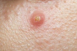 Boils And Fever: When Fever Accompanies A Boil, What Does It Mean?