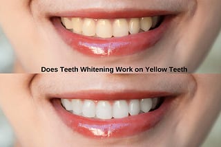 “Explore the effectiveness of teeth whitening on yellow teeth. Learn about professional treatments, dentist techniques, and home remedies. Discover the best options in Millbrae for a radiant smile.”