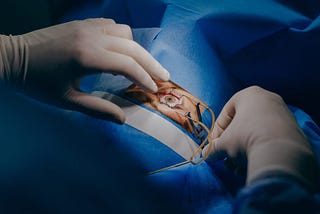 Cataract Surgery in Ahmedabad — Regain Clear Vision