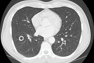 Image of author’s lungs showing a 2 cm lesion in his lower right lobe