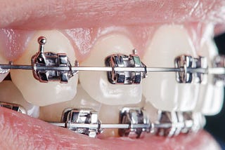Metal Braces Boca Raton FL