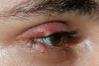 Dealing with Styes: Causes, Symptoms, and Effective Treatments