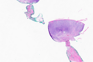 Primary Skin DLBCL in the Leg