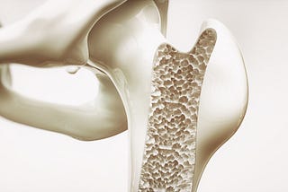 The Nuance in Treating Osteoporosis: Research Updates and Approaches