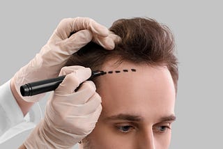 Hair Transplantation - Natural, Long-Lasting Results
Hair transplantation has come a long way!