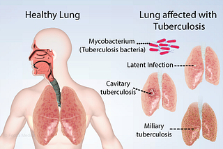 Tuberculosis Symptoms: