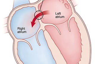 Atrial Septal Defect in Children