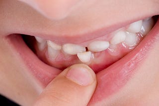 Why Are My Front Teeth Loose? Causes and Solutions