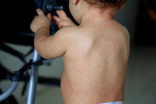 Why Are Measles Cases Rising in the US