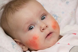 Eczema in Babies: Treating Eczema Of The Hands, Causes And Treatments