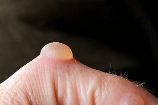 Awsome ways to get Rid of Blisters!