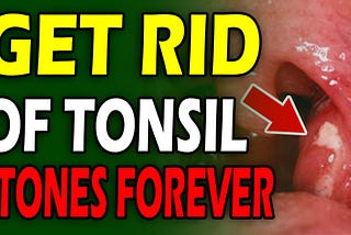 The Simplest Way to Remove Tonsil Stones