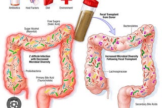 Fecal Microbiota Transplant (FMT): Process, Indication, Outcome