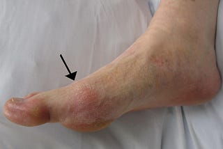My Medical Problems Persist With Gout