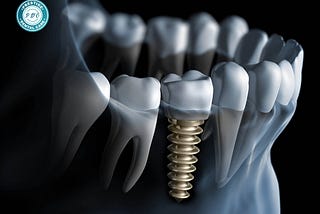 Top-Quality Dental Implants in Flushing at Prestige Dental Care