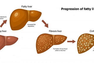 Complications & Causes of Fatty Liver