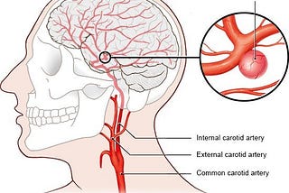 Recovery after brain aneurysm