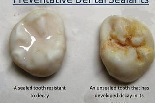 ALL ABOUT DENTAL SEALANTS