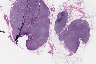 Nodal Mantle Cell Lymphoma, Nodular Growth Pattern