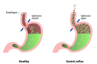 Ways to Prevent Heartburn and Acid Reflux