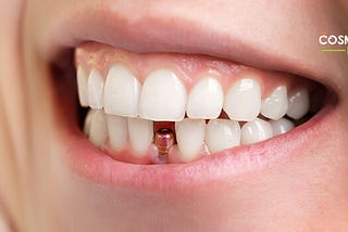 Benefits of Dental Implants and the Best Place for It - Cosmodent