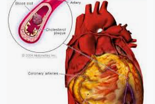 http://myinfojet.blogspot.com/2021/11/heart-attack.html