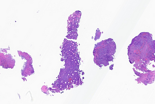 DLBCL in Stomach Biopsy, EBV+, Post Transplant Setting (History of AML)