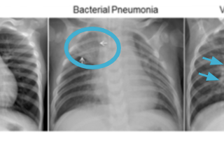 Computer Vision and Pneumonia Detection Part 1: Technical